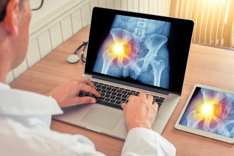 Bursitis de cadera: síntomas y tratamiento
