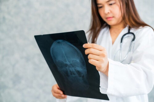 Alzheimer precoz: todo lo que debes saber