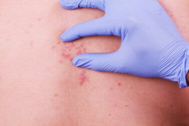 ¿Cuánto dura el dolor y los síntomas del herpes zóster?