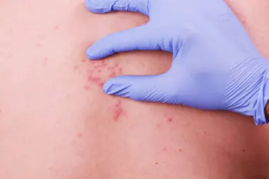 ¿Cuánto dura el dolor y los síntomas del herpes zóster?
