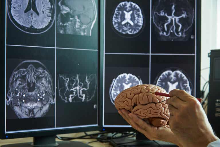 Ictus cerebral: síntomas, causas y tratamiento
