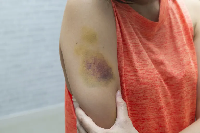 ¿Por qué los moretones cambian de color?