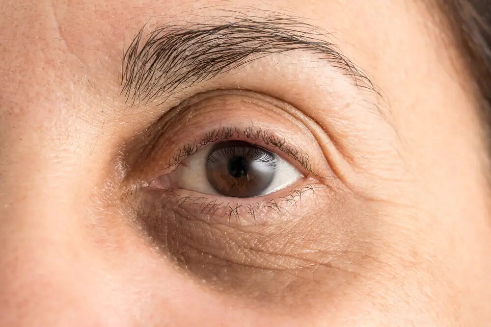 Ojeras y sus posibles causas