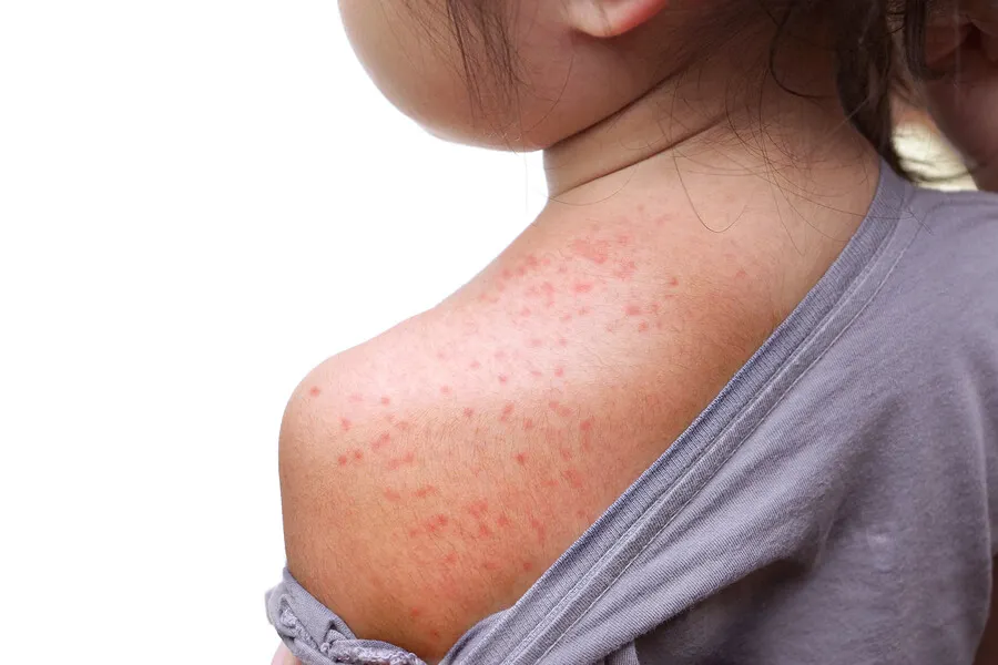 ¿Qué es la psoriasis Guttata?