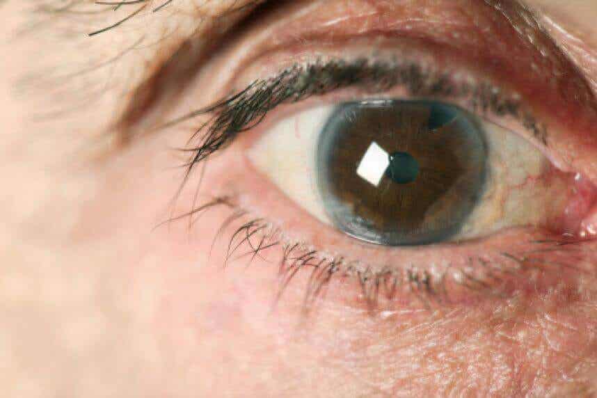 Paciente con glaucoma