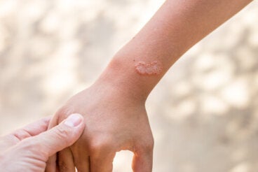 Infestación por sarna - Trastornos de la piel - Manuale Merck versión para  el público general