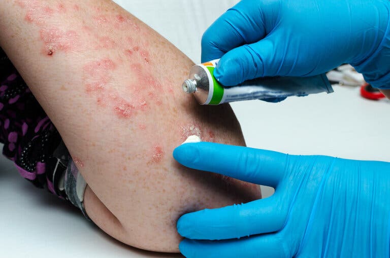 Psoriasis en gota (guttata): causas y tratamientos