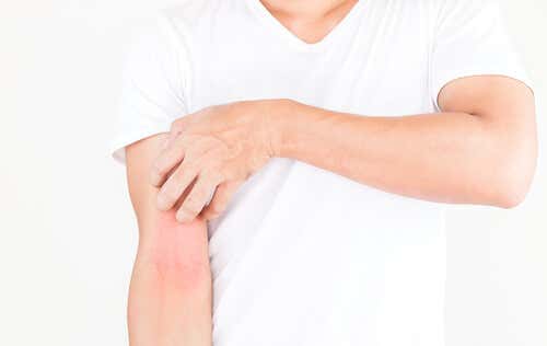Dermatitis en el brazo