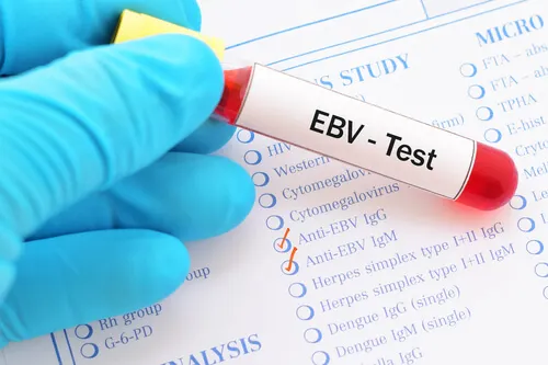 Virus de Epstein-Barr causa mononucleosis