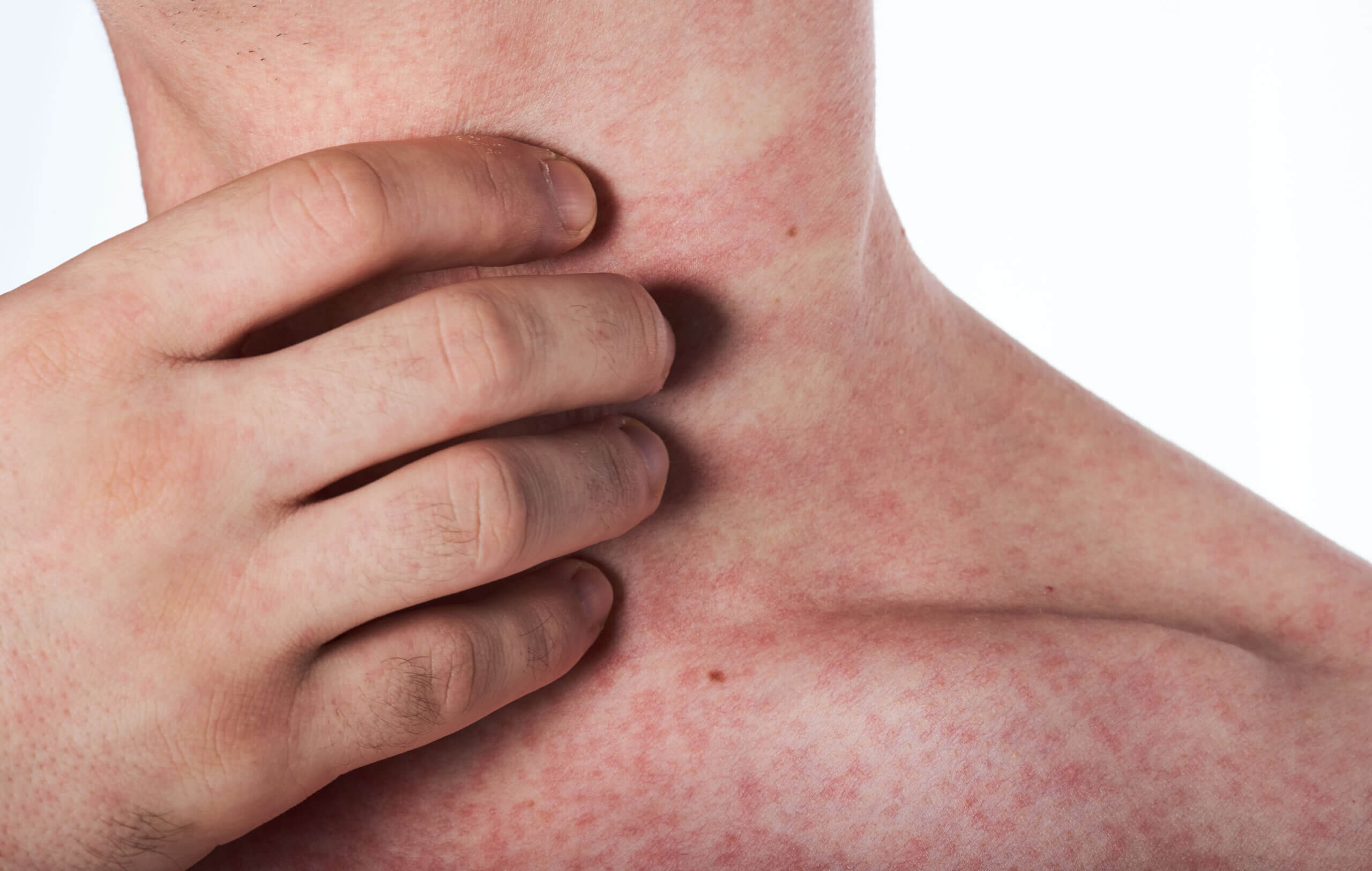 Las manchas rojas en la piel en las alergias