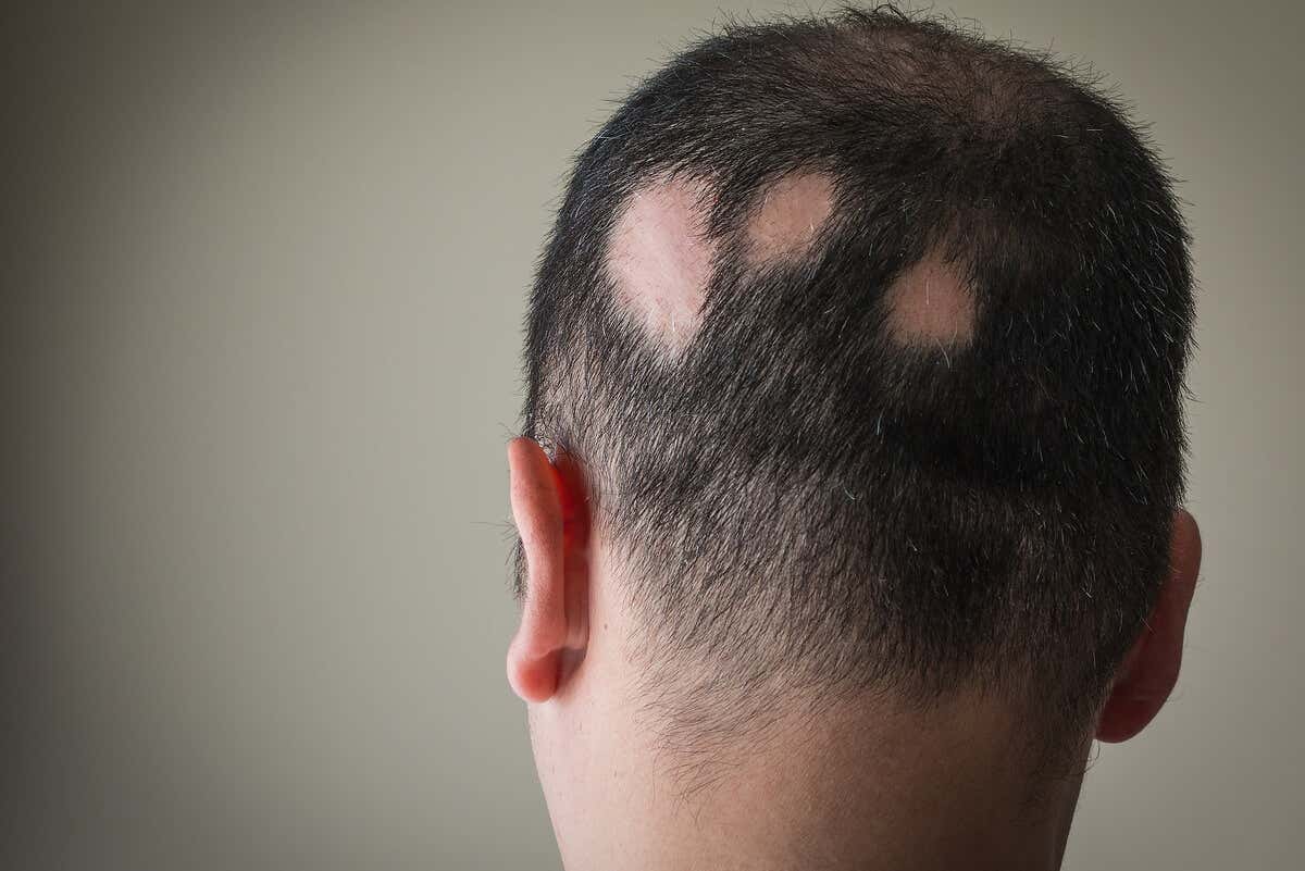 Alopecia por costras en el cuero cabelludo.