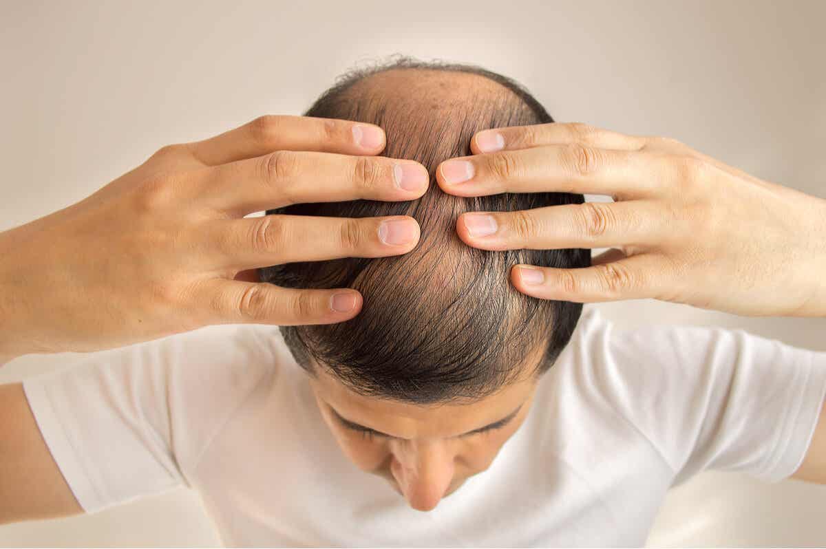 Alopecia in men.