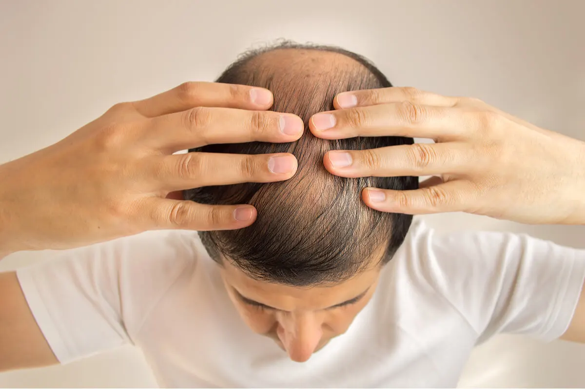 Alopecia masculina