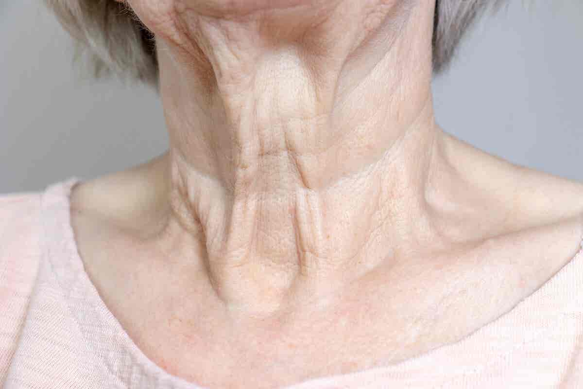 Arrugas en la zona frontal del cuello.