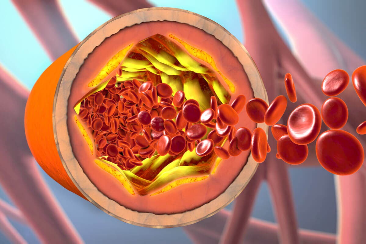 ¿En qué consiste una angina de pecho?