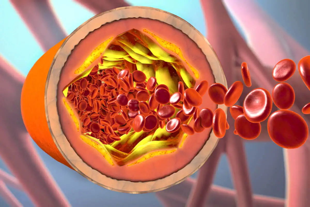 ¿En qué consiste una angina de pecho?
