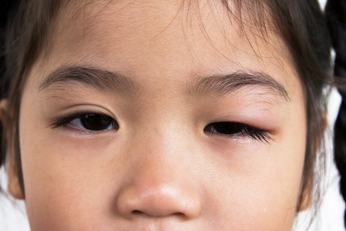 Blefaritis en niña