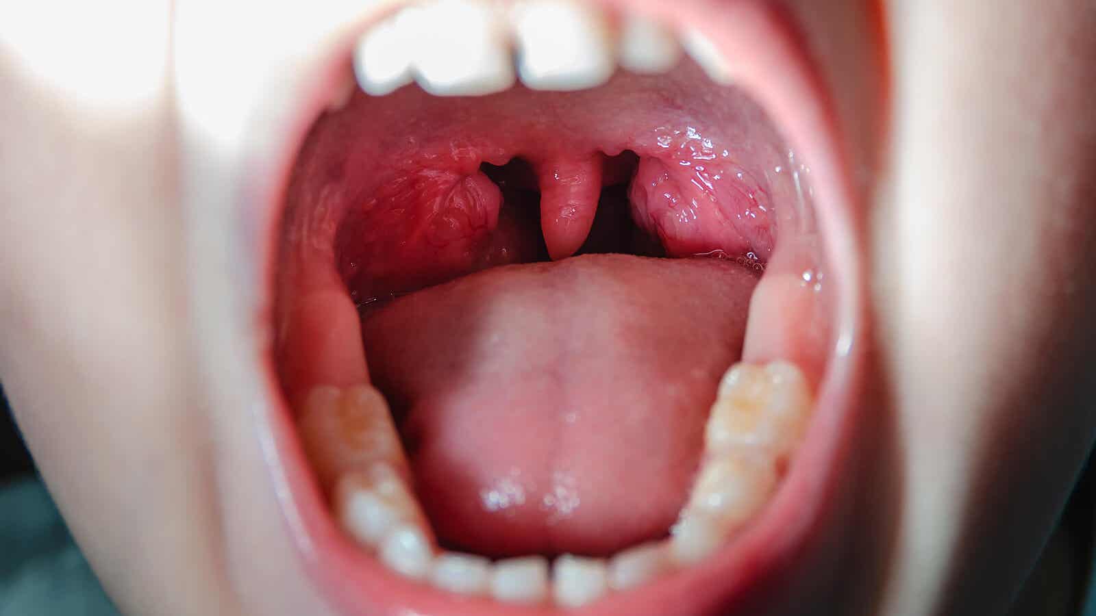 Faringitis En Perros Es Contagiosa Faringitis estreptocócica: síntomas y tratamiento - Mejor con Salud