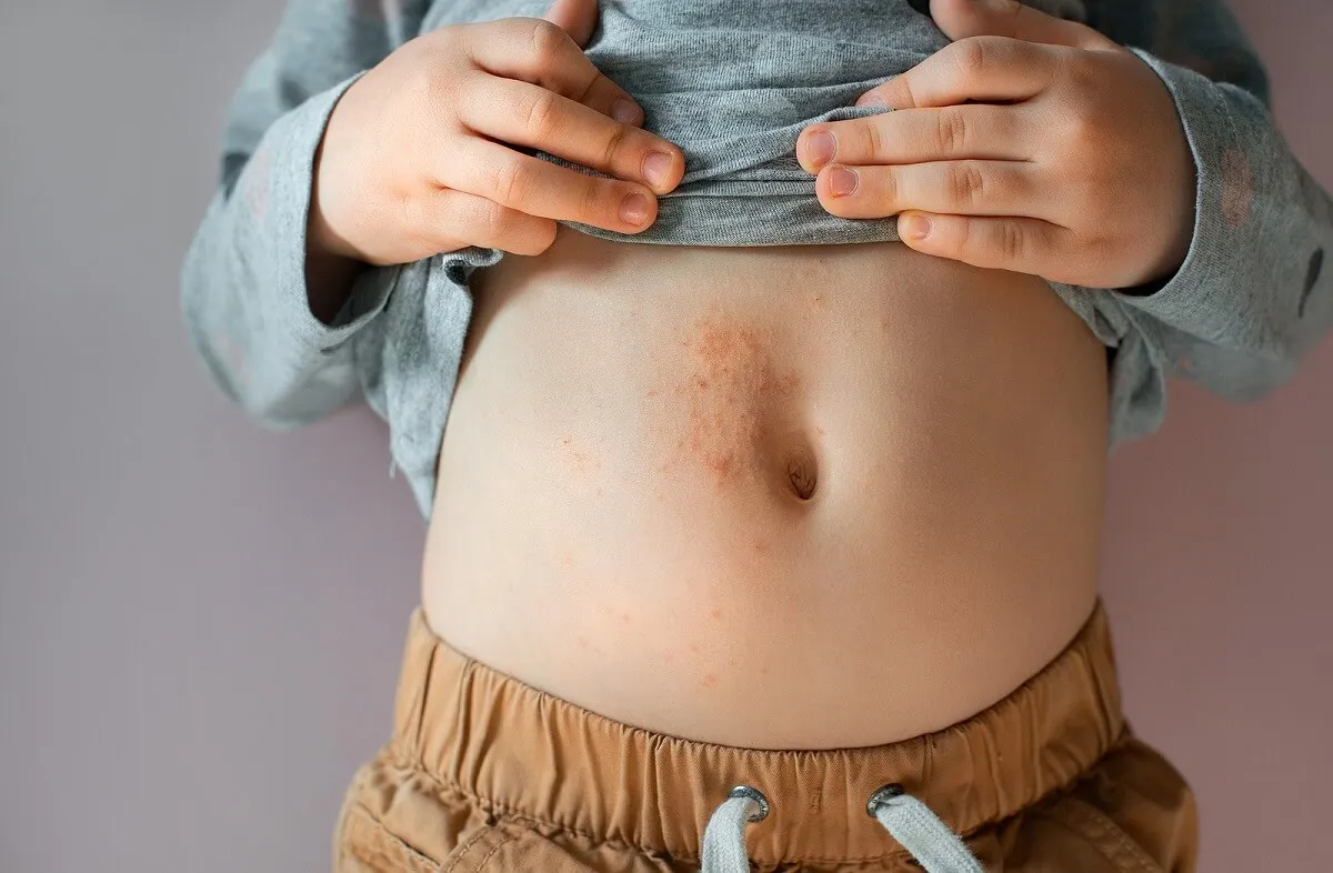 Cómo tratar la dermatitis atópica en niños