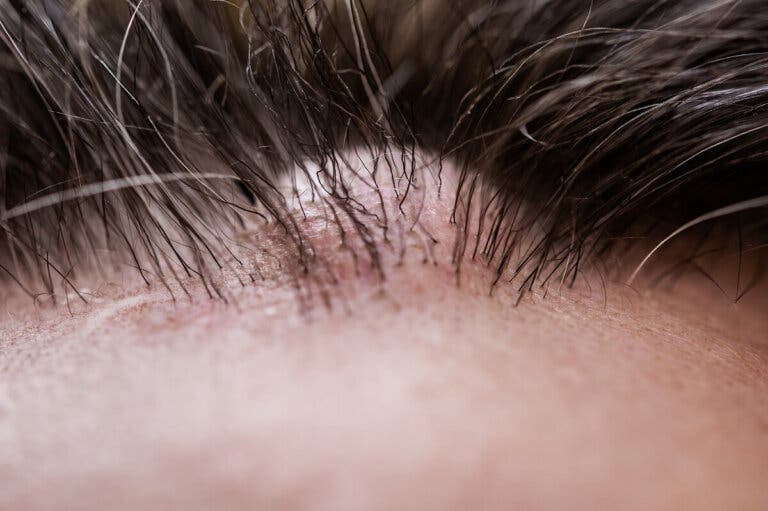 ¿Qué es un dermatofibroma?