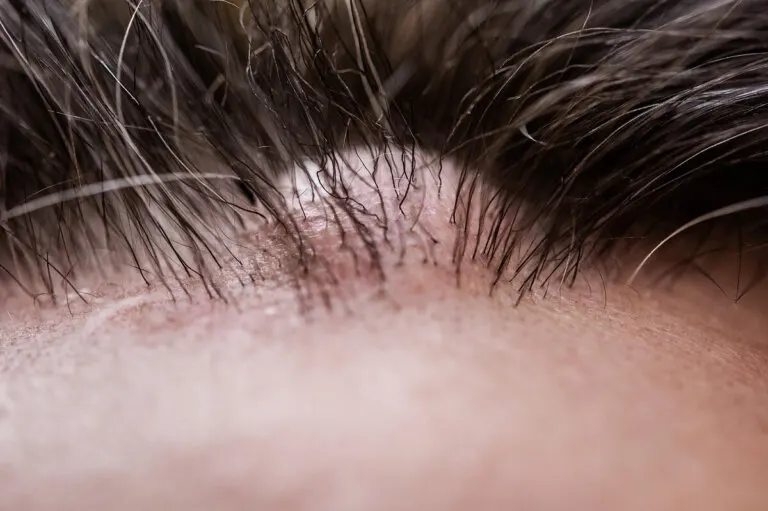 ¿Qué es un dermatofibroma?