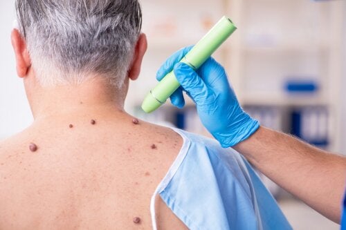 ¿Por qué sangran las verrugas?