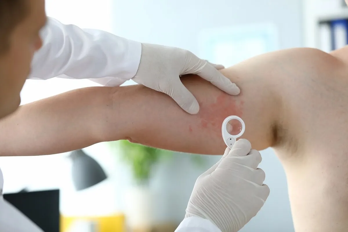 Dermatitis de contacto revisada por médico.