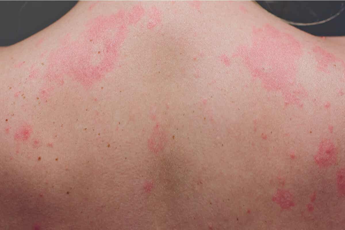 Urticaria por alergia a perros y gatos.