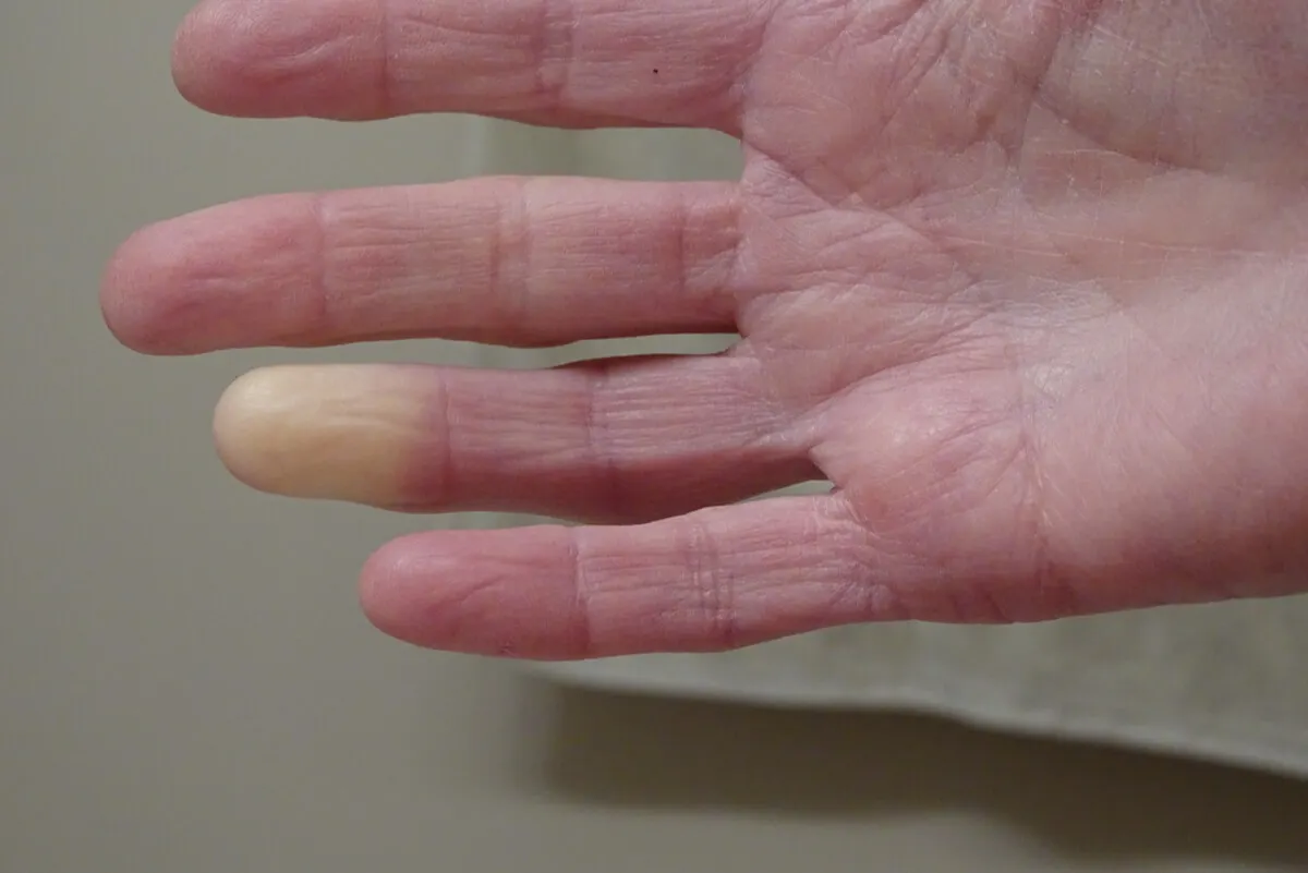 Fenómeno de Raynaud con piel pálida