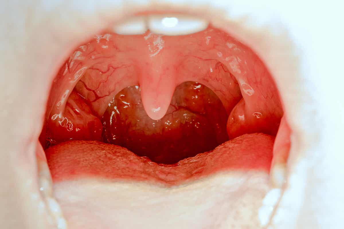 Infecciones asociadas al pus en la garganta