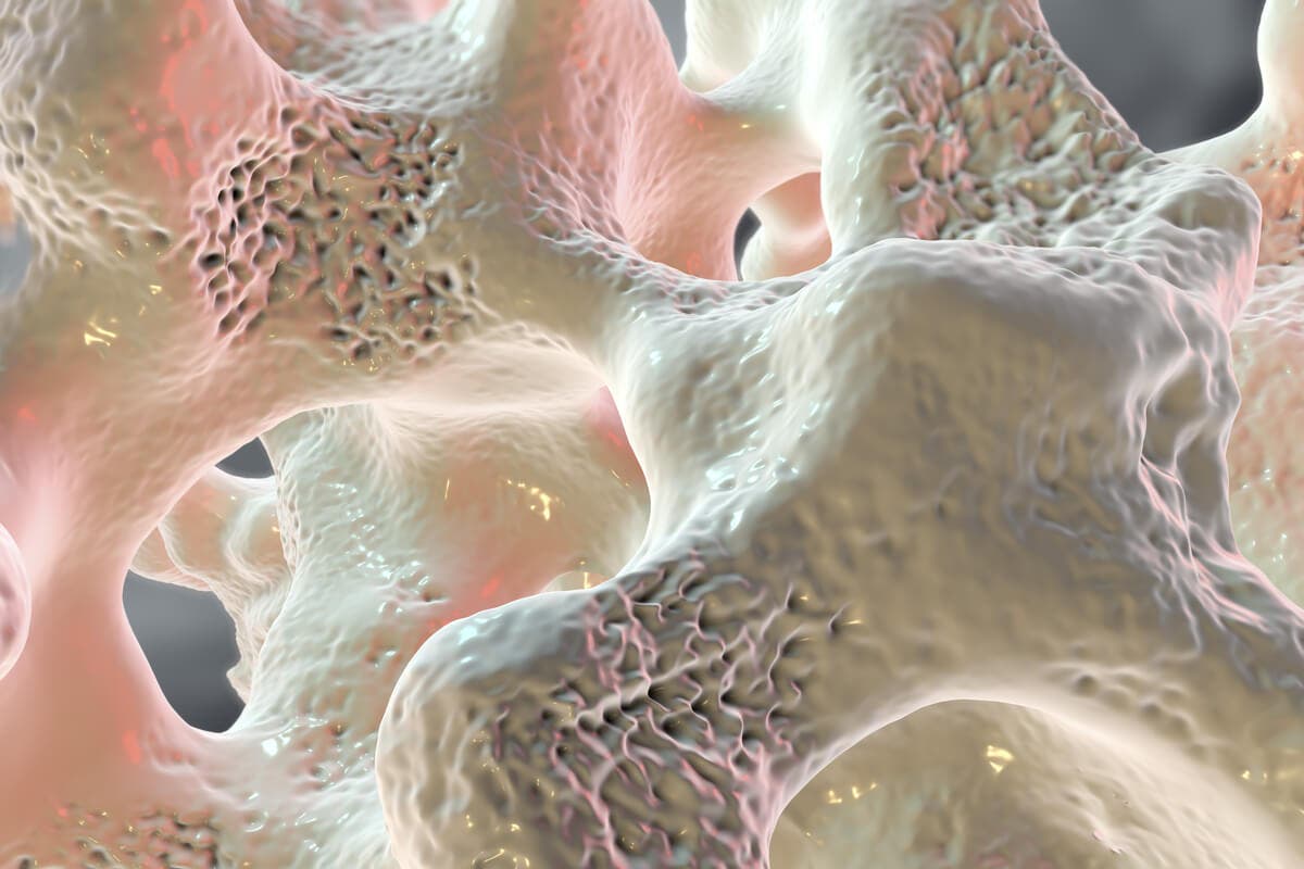 Hueso con osteoporosis.