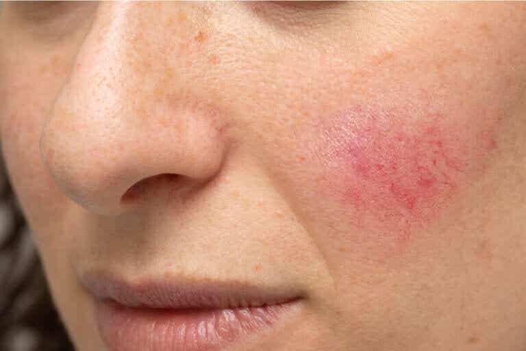 Lesiones en la piel por exposición solar