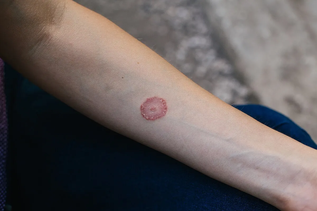 Micosis o pitiriasis versicolor