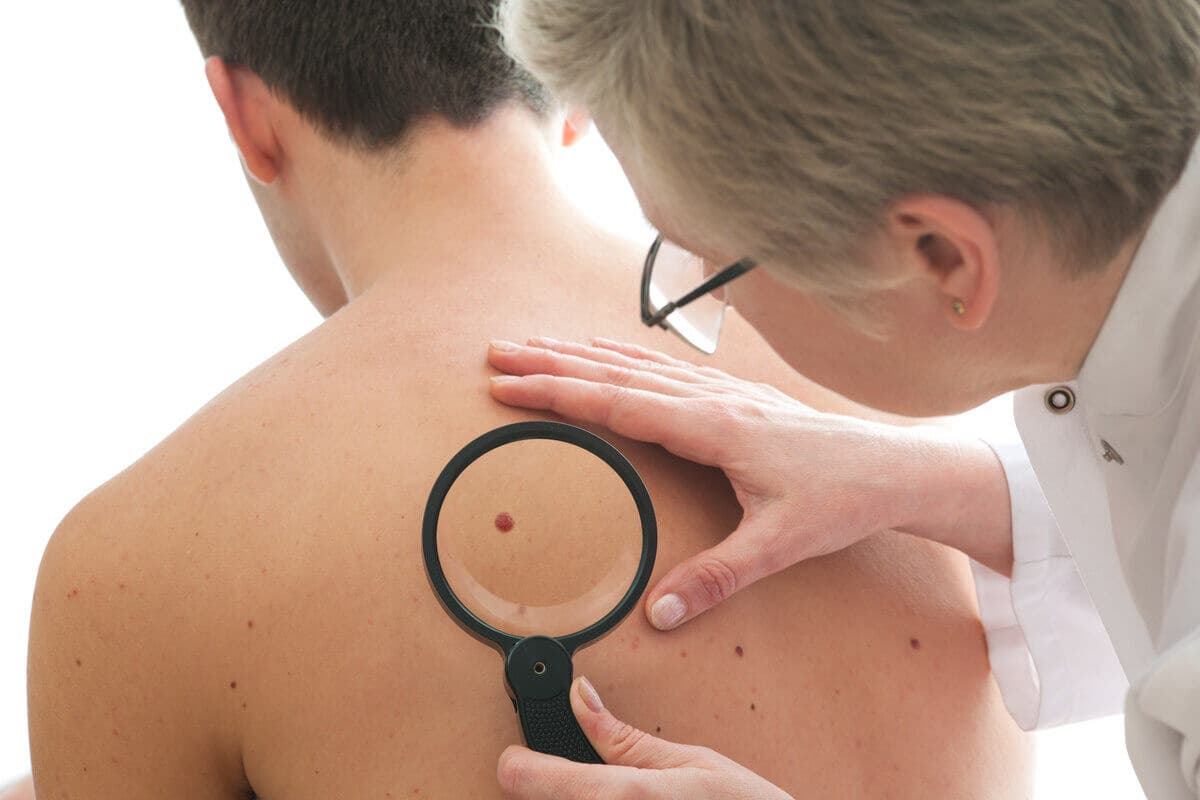 Diagnóstico del dermatofibroma