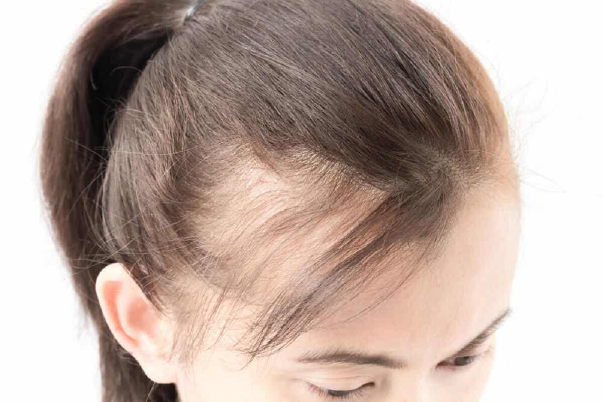 ¿Qué otros factores se asocian a la alopecia femenina? 