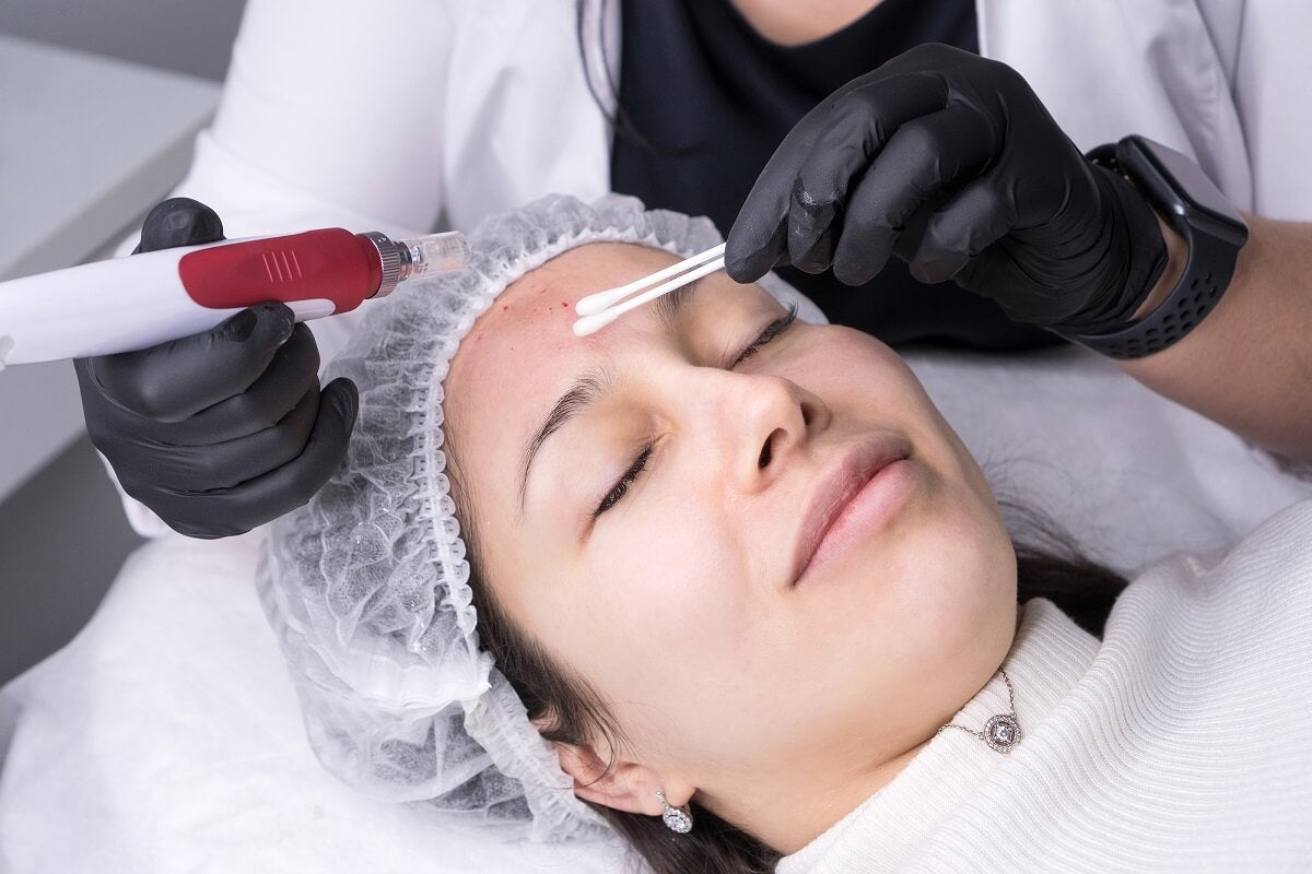 Microagulhamento em uma mulher recebendo um tratamento facial de vampiro.
