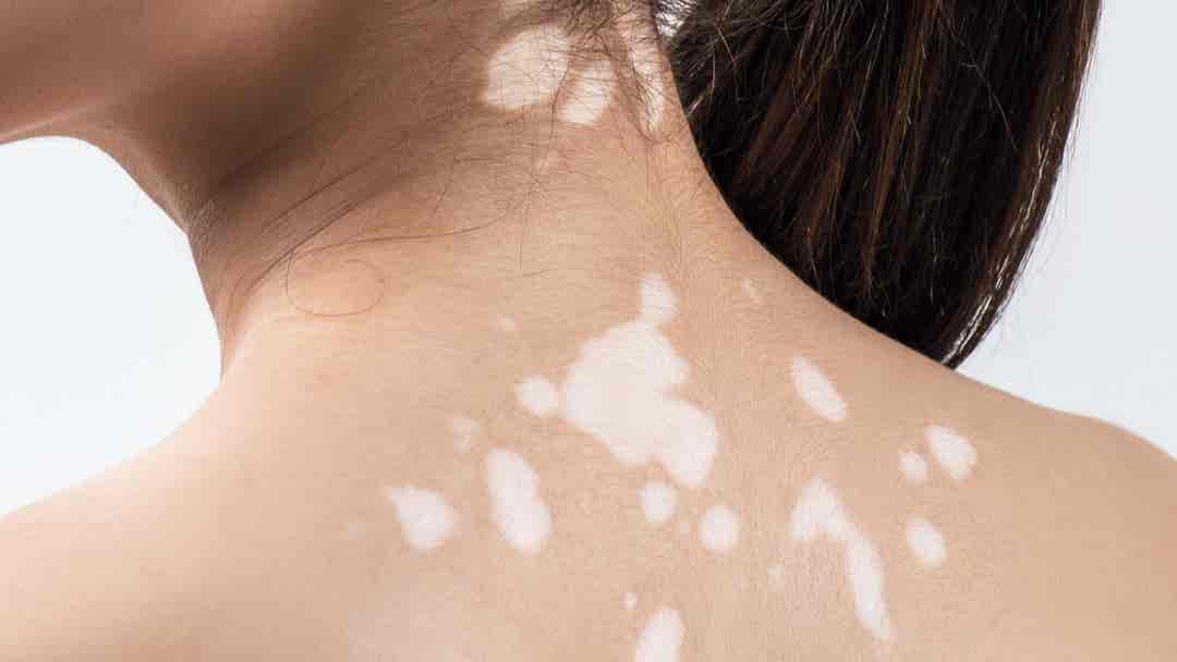 10 doenças que causam manchas brancas no rosto