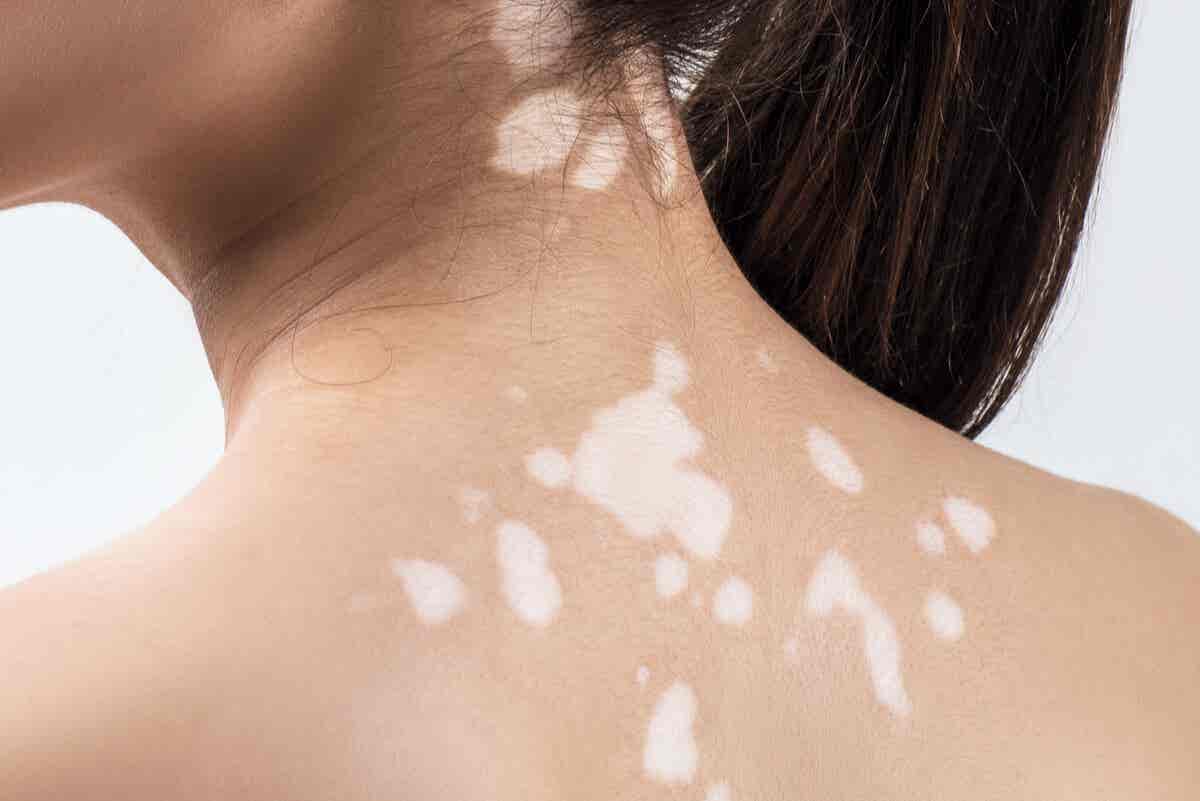 10 doenças que causam manchas brancas no rosto