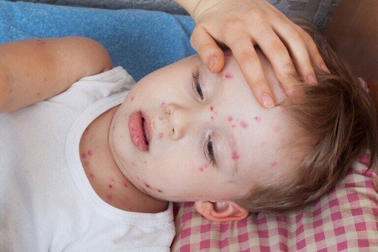 Urticaria en niños: ¿cómo tratarla?