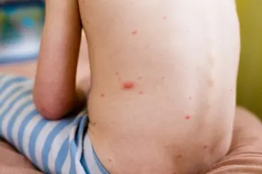 Remedios caseros para tratar la urticaria en niños