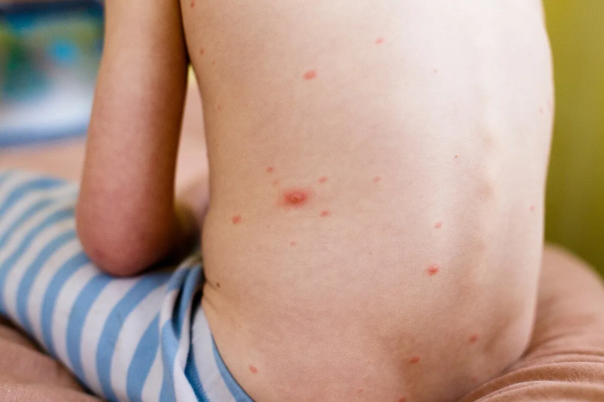 Urticaria en la espalda de los niños.