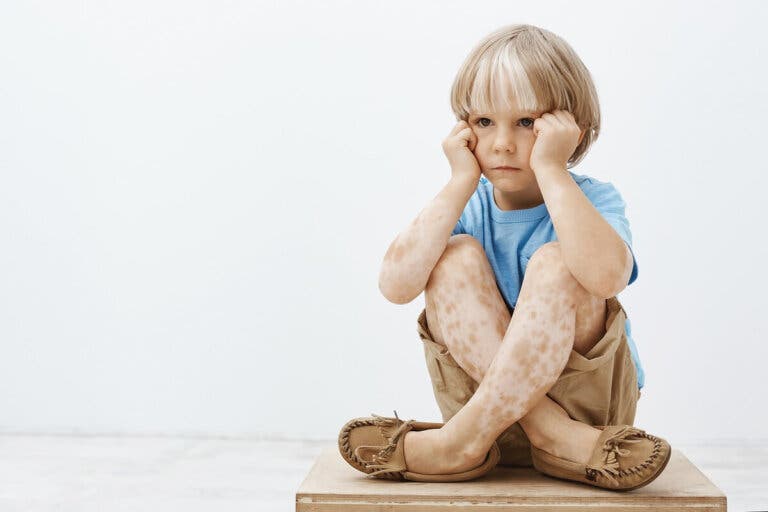 Vitíligo en niños: consejos para tener en cuenta