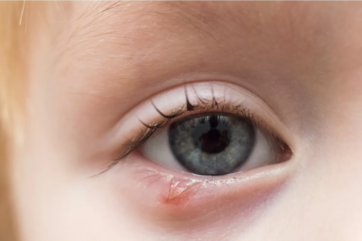 A chalazion.
