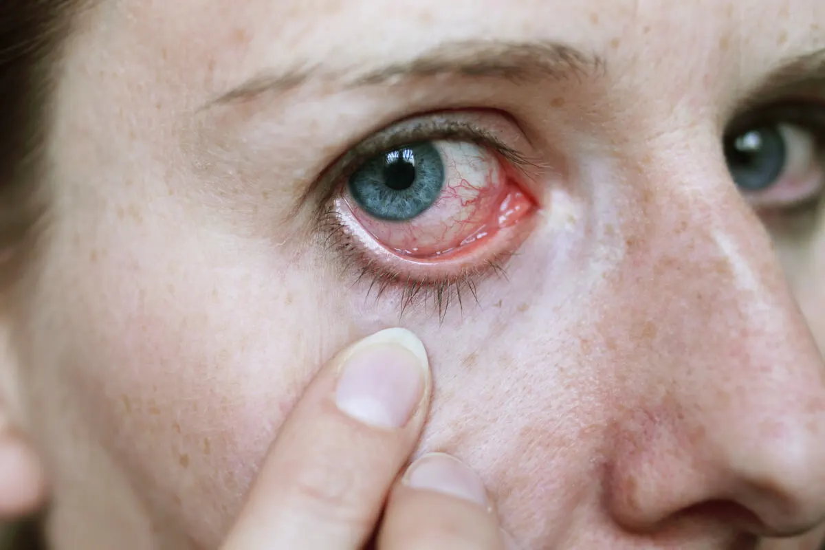 Conjuntivitis por pestañas postizas.