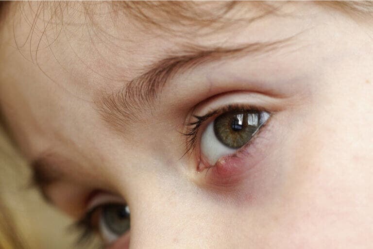 Orzuelos en niños: ¿cuál es el mejor tratamiento?