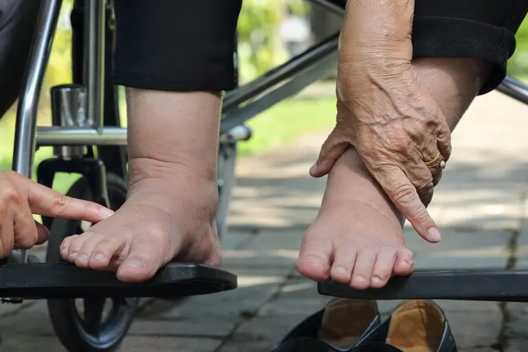 Consejos para cuidar el pie diabético durante el verano