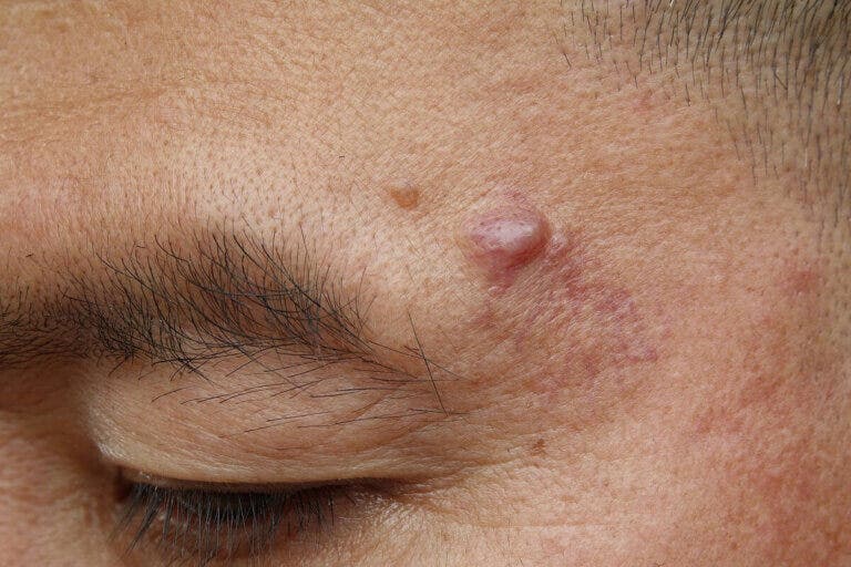 Protuberancia dura debajo de la piel: ¿a qué se debe?
