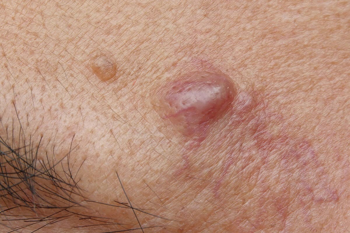 ¿Por qué se generan los quistes epidermoides?