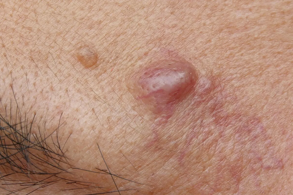Quistes epidermoides