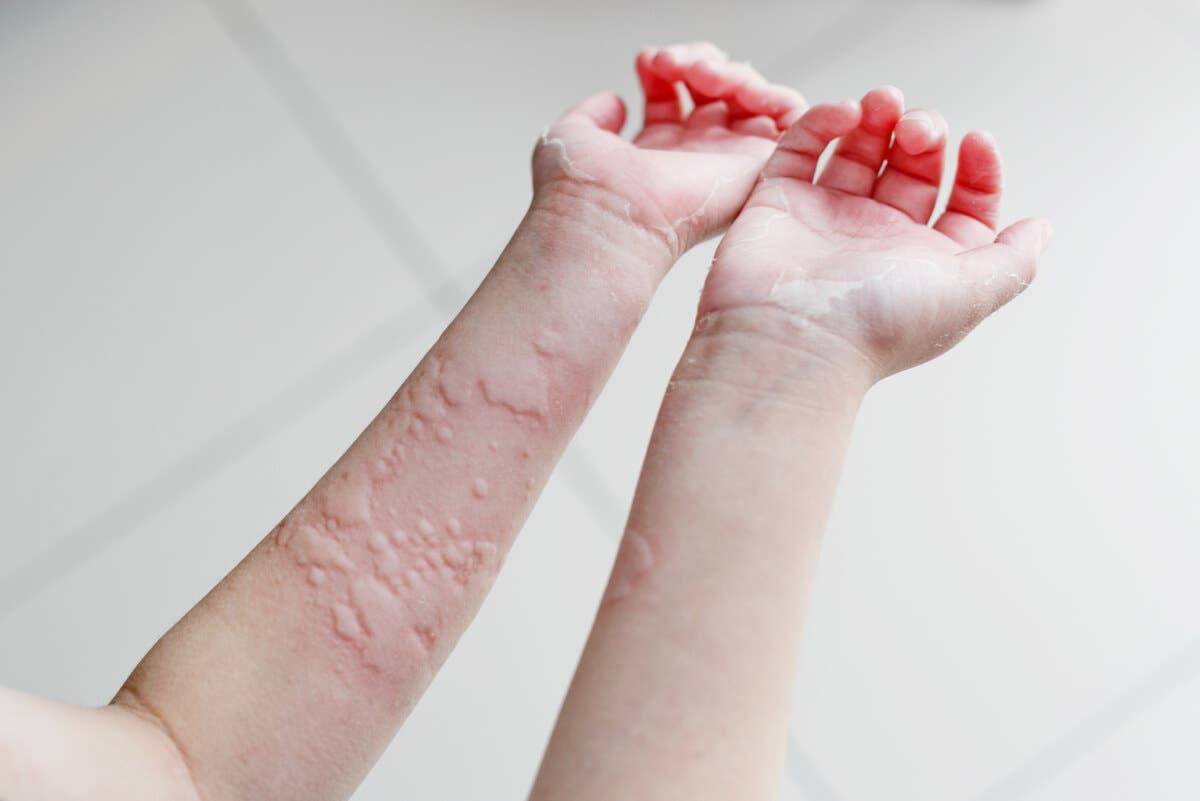 Urticaria en los brazos.